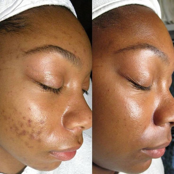 Dark Spot Serum for Normal Skin